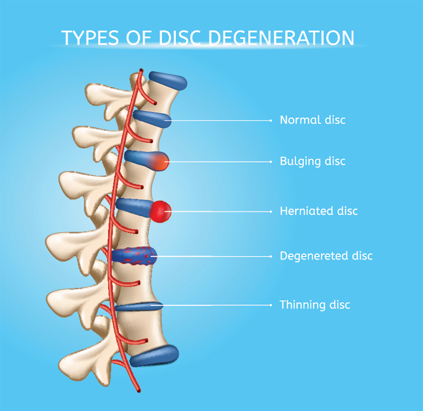 disc degeneration