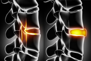 herniated disc