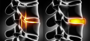 herniated discs