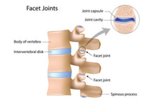 facet joint pain