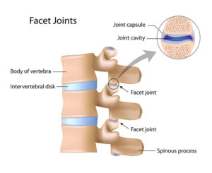 https://www.h-wave.com/wp-content/uploads/2020/01/facet-joint-pain-treatments_850-300x245.jpg