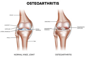 osteoarthritis knee compared to healthy knee